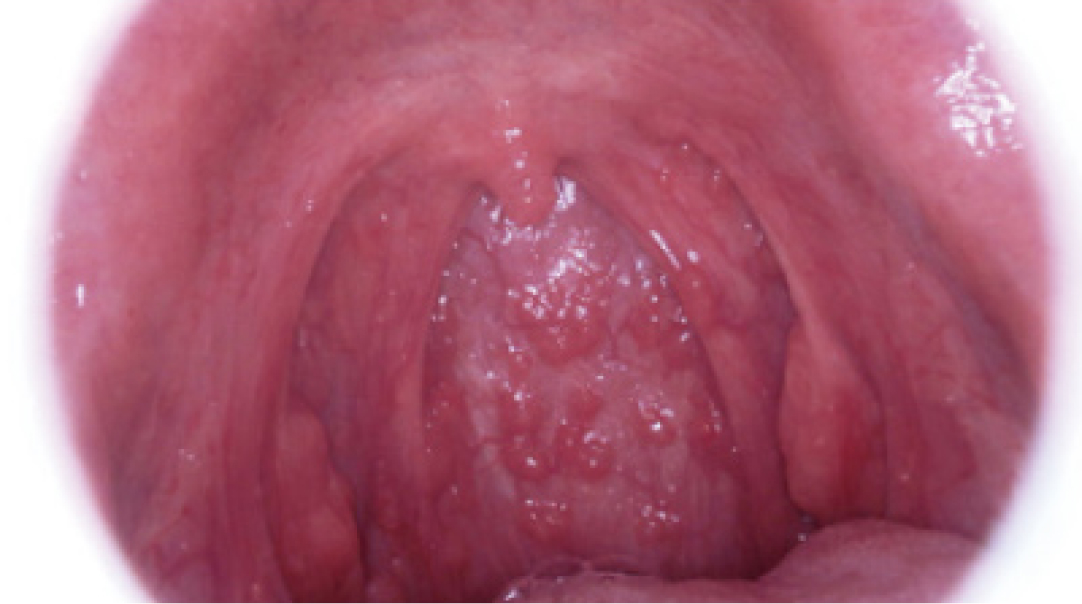 鼻に綿棒をいれないインフルエンザ検査